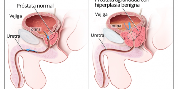 Hiperplasia benigna de próstata | Foto: Kimedia